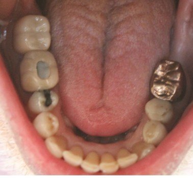 Invisalign®  Dentist in Boise, ID
